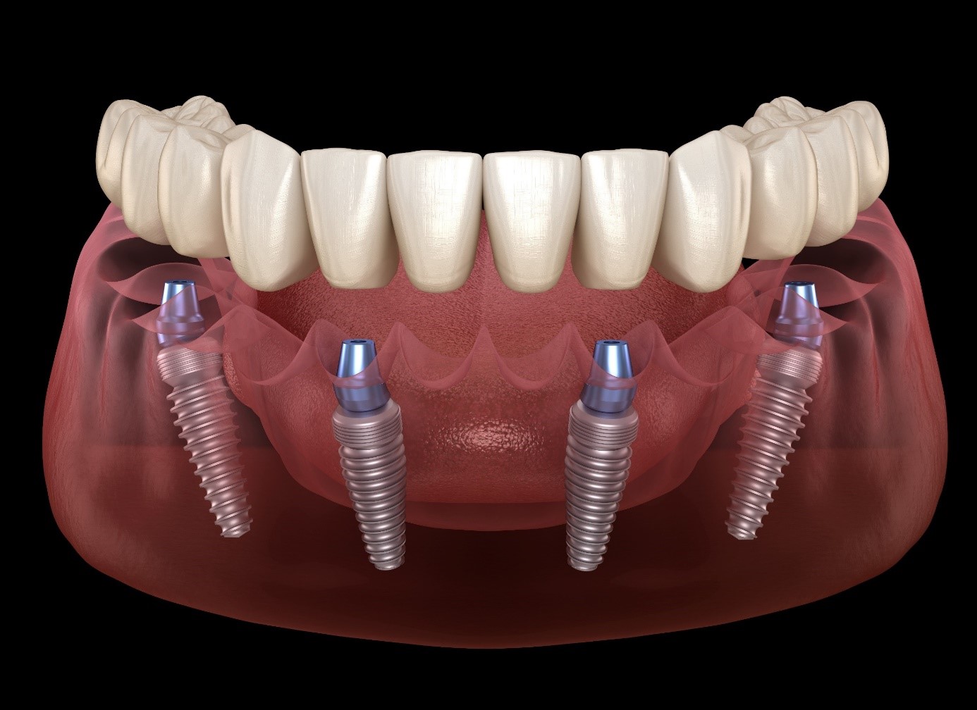 Dalux impianti dentali