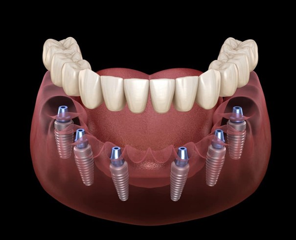 Dalux tecnica all on 6